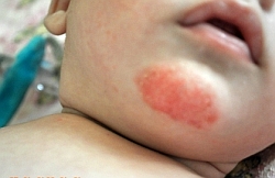 Аллергический дерматит у детей (Детский диатез) - Как лечить и симптомы